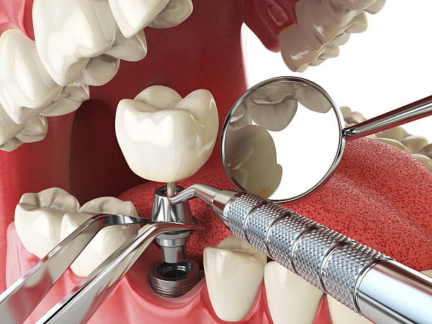 Best Emergency Tooth Extraction in Hayden, ID